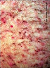 pedicoulosis pedicoulosis